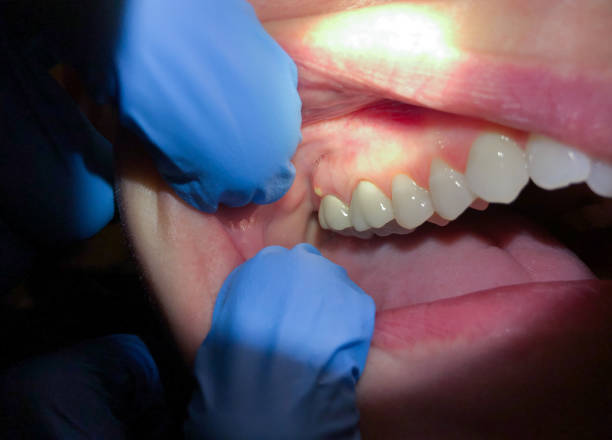 Best Emergency Wisdom Tooth Extraction in Ada, MN